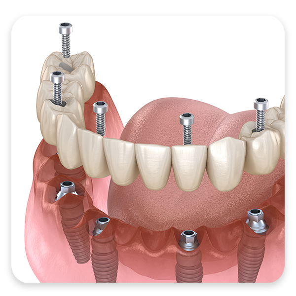 Implant Denture