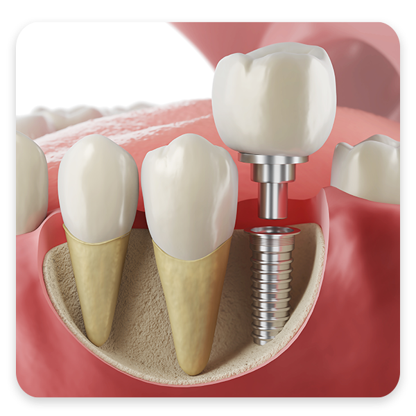 Dental implant in jaw